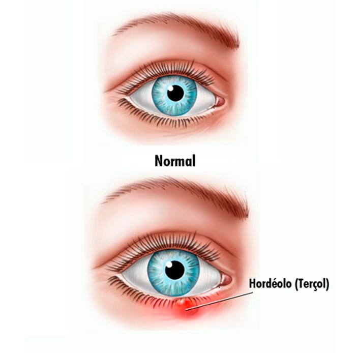 Hordeolo / Terçol : quais sāo os sintomas, como evitar e o